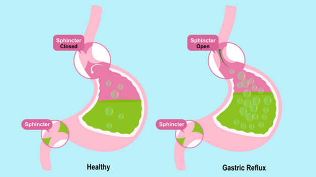 What Are The Treatments For Acid Reflux